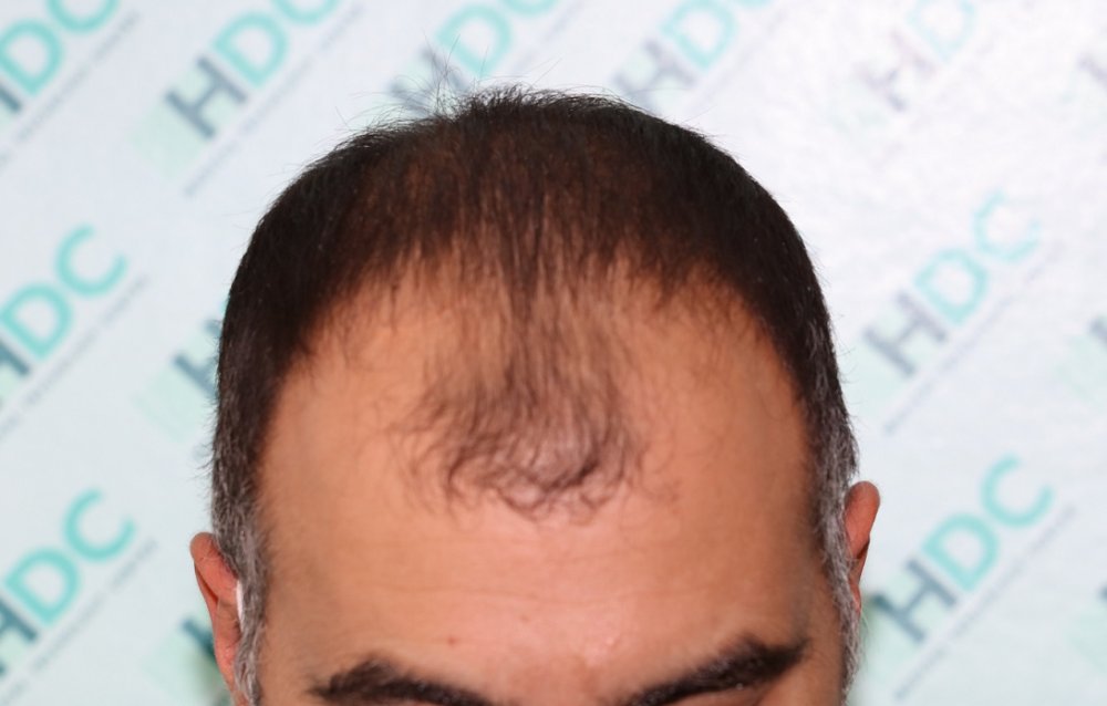 1. Before Front.JPG