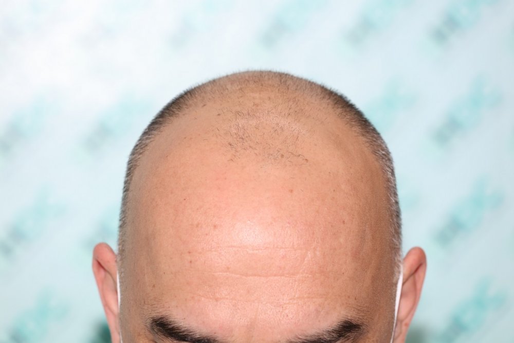 1. Before Front.JPG