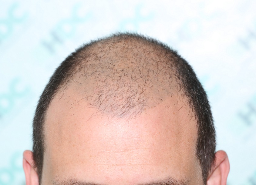 1 - Before Front.JPG