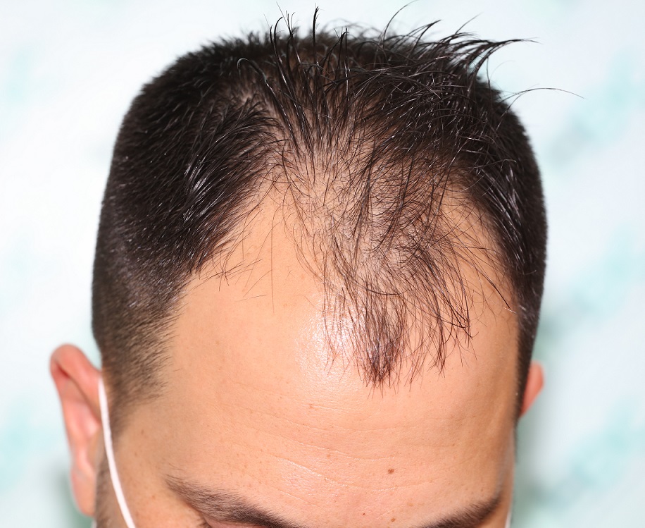 1. Before Front.JPG