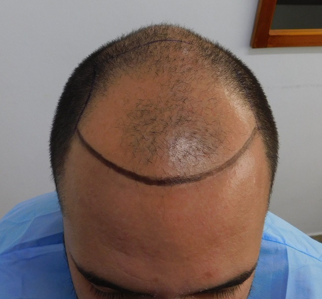 1. Before Front.JPG