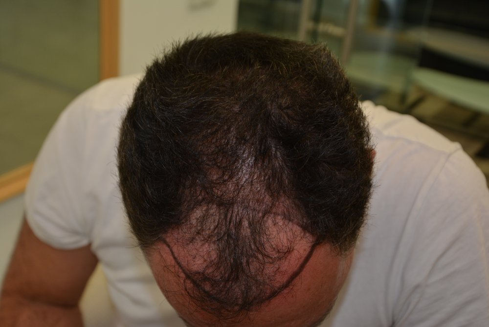 1. Before FUE1.JPG