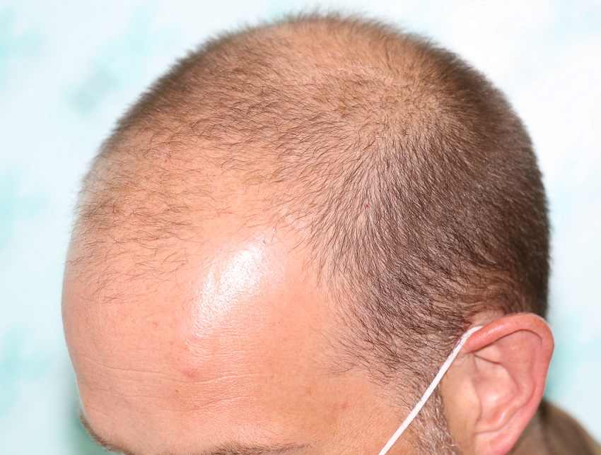 1. Before FUE1 - Left.JPG