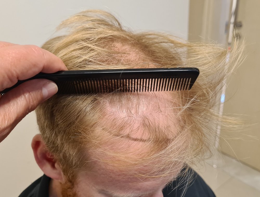 1. Before Right with Hairline Design.jpg
