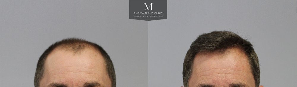 1-Before_After_front-.jpg