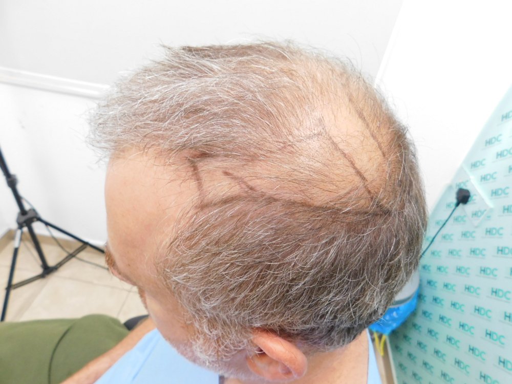 1. Connect top hair with donor - Left.JPG