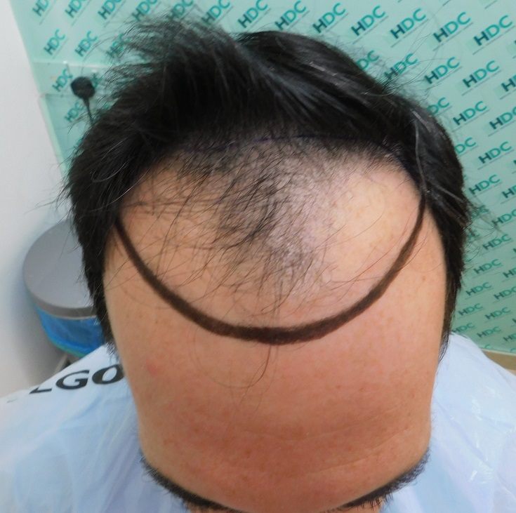 1. Design before surgery.JPG