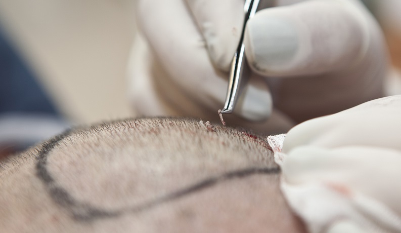 1. hair-transplant-graft-placement.jpg