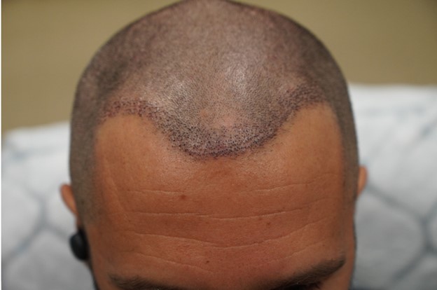 1. Hairline pre-1st surgery.jpg