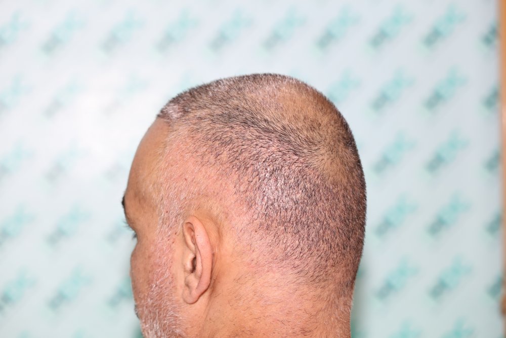 10. 1 wiik after left side donor.JPG