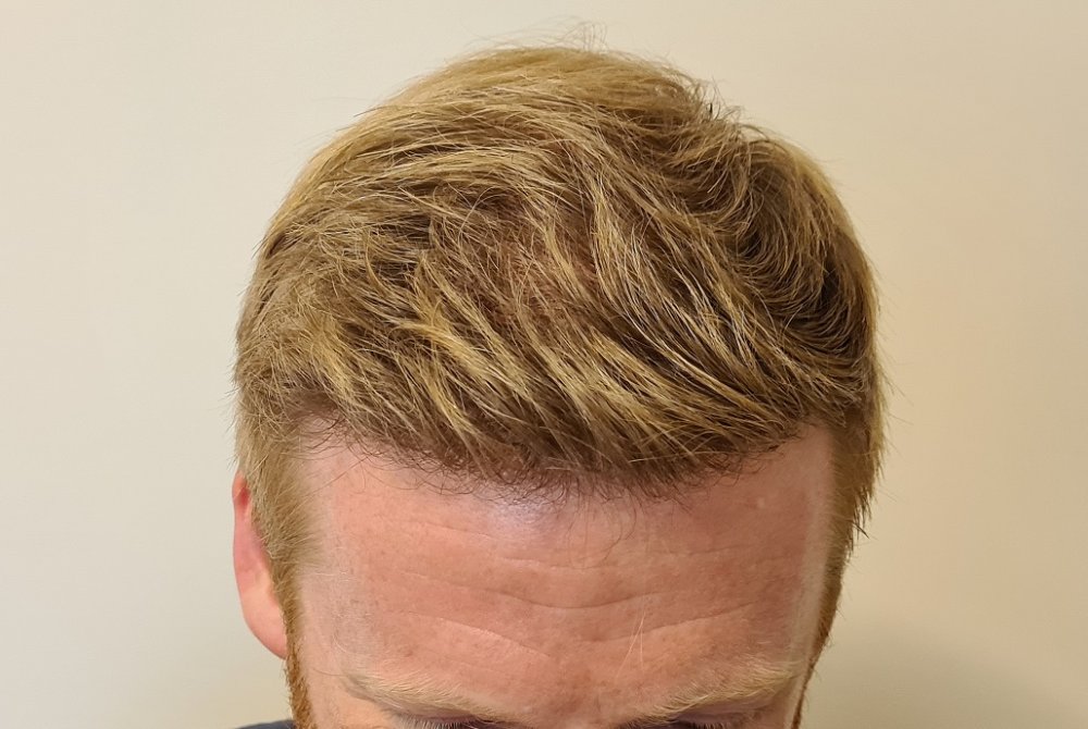 10. After 7 Months Front top.jpg