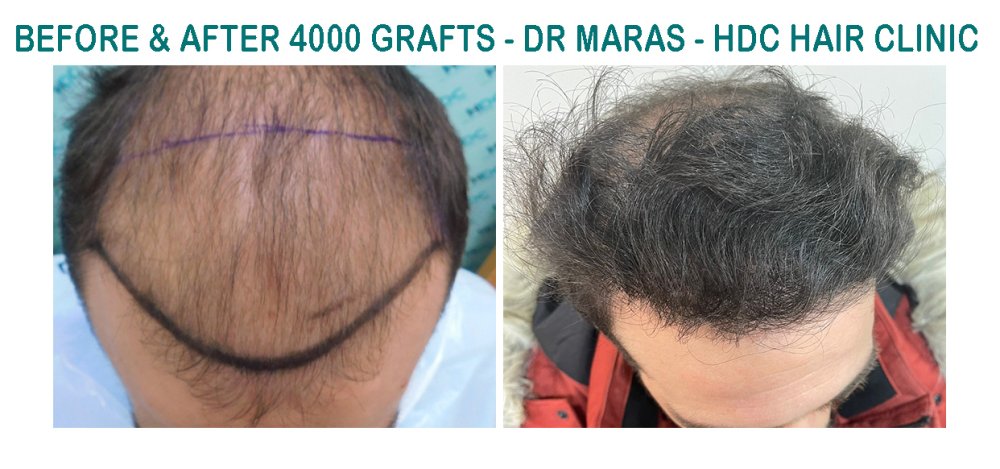 10. Medium 4000 grafts -.jpg