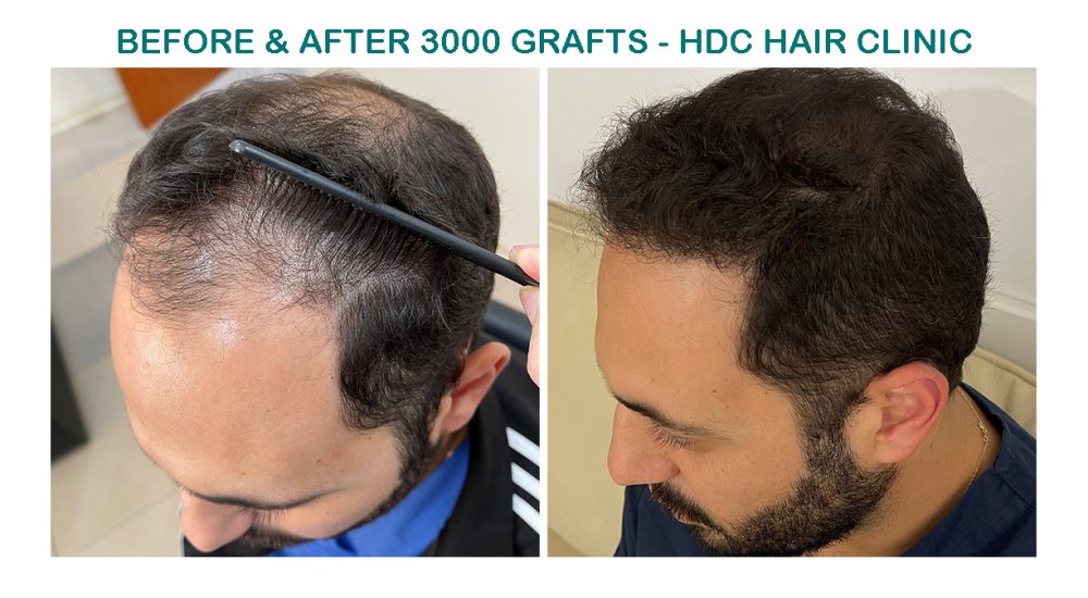 10. Medium Aristos Set 2 for 3000 Grafts  HT 25-01-21.jpg