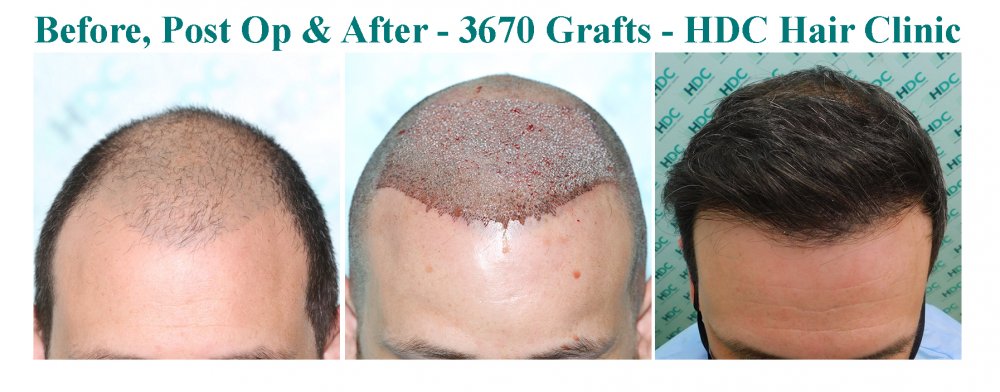 10 - Medium Density  HT 28-09-20 for 3670 grafts - Front 1.jpg