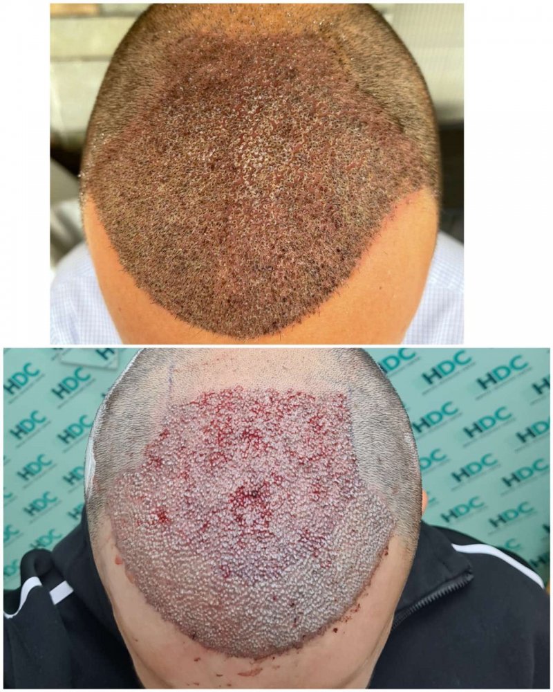 10. Post op and 48 hours After.jpg