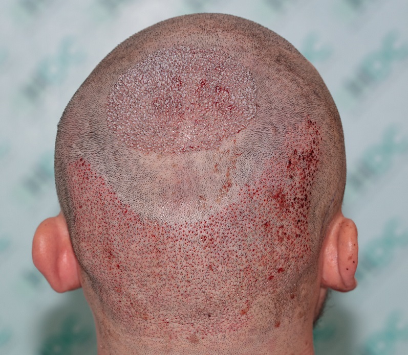 10. Psor op Crown with 2210 Grafts.JPG