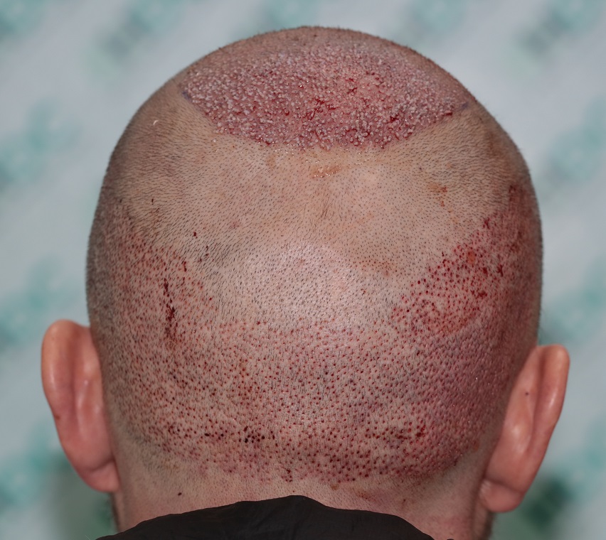 10. Punched back donor.JPG