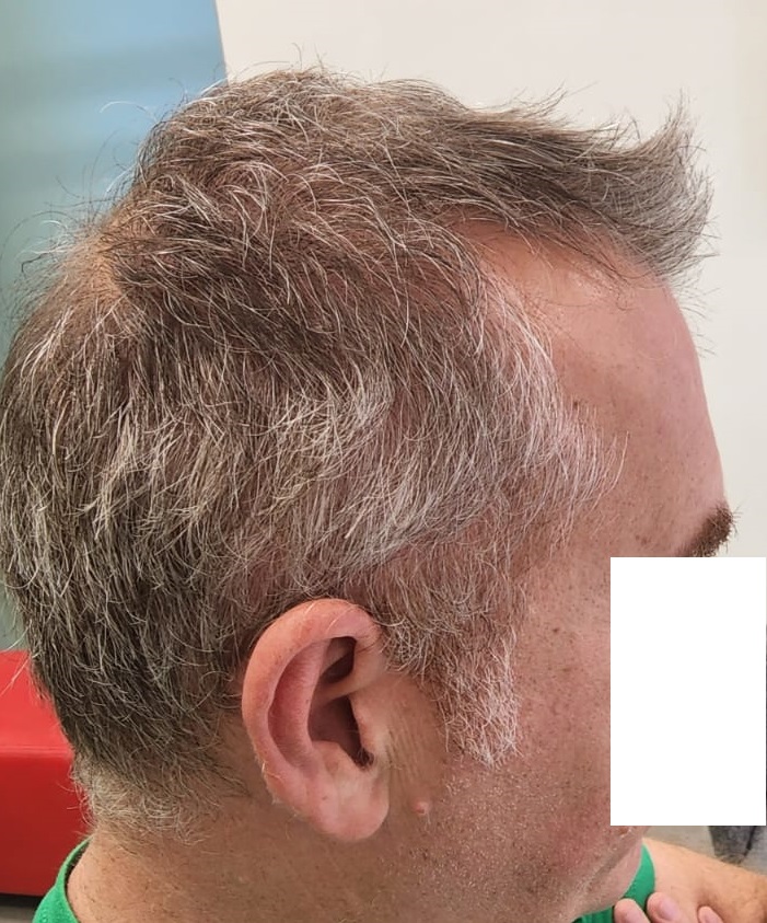 10. Result of Connection of top hair with donor - Right.jpg