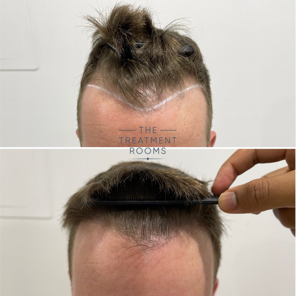 1073 grafts fue hair transplant before and after closeup.jpg