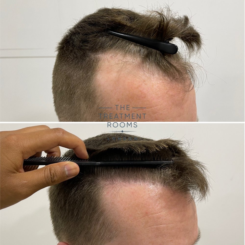 1073 grafts fue hair transplant before and after right temple.jpg