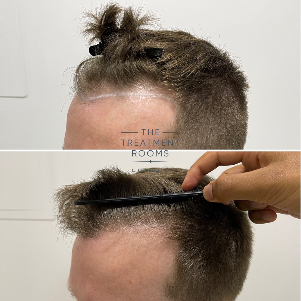 1073 grafts temple fue hair transplant before and after closeup.jpg