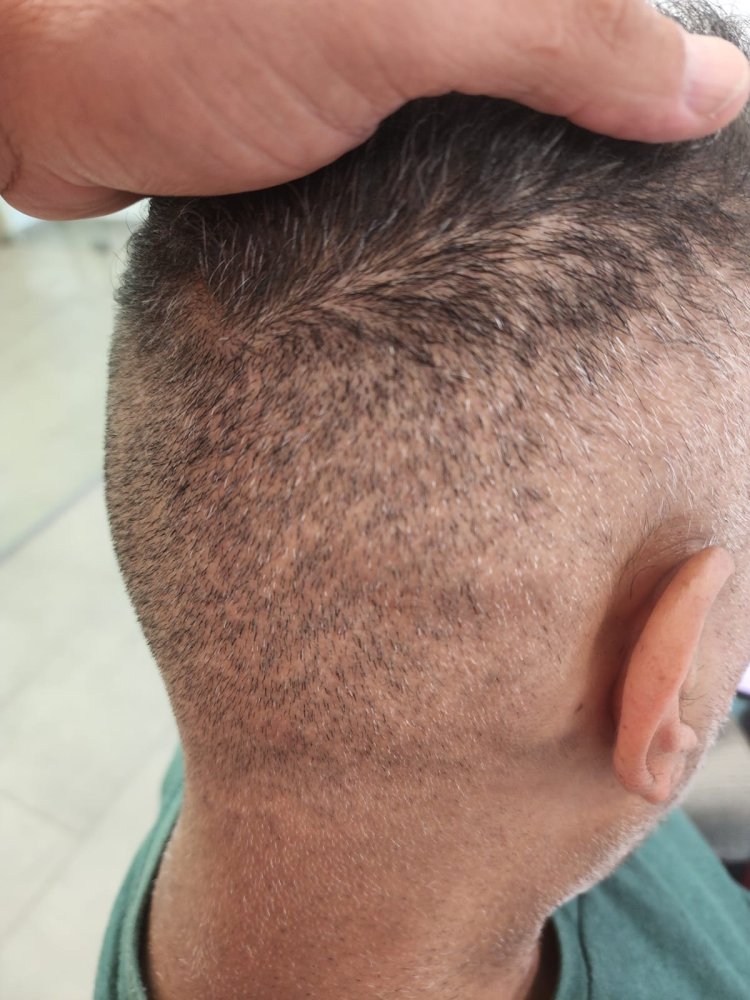 11. 2.5 years after FUE2.jpg