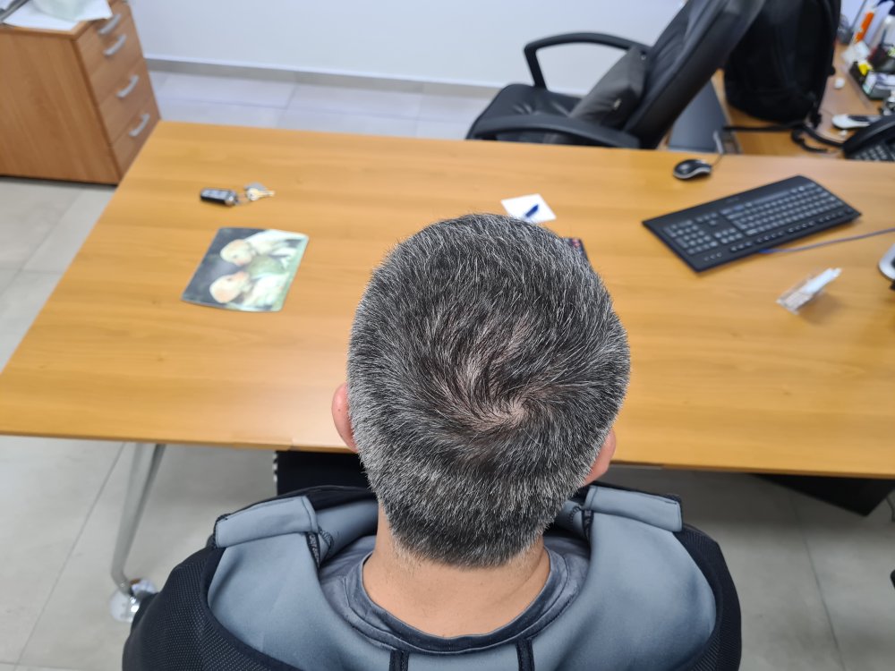 11. Crown 15 months after.jpg