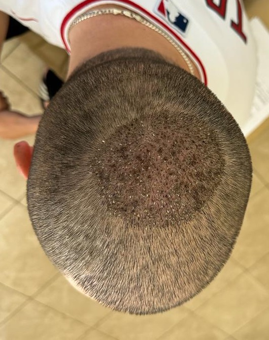 11. Four days After Crown FUE.jpg