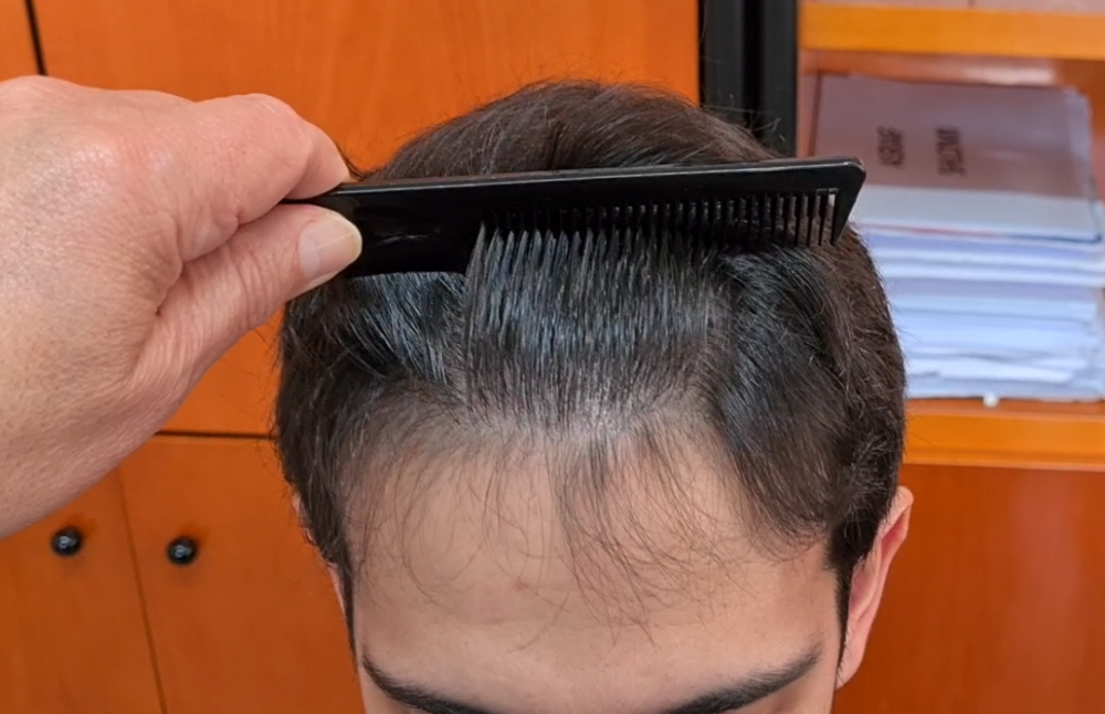 11. hairline naturality.png