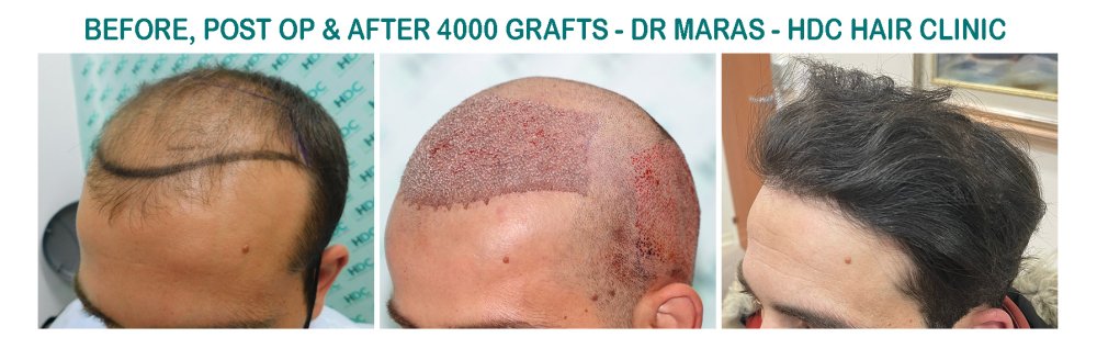 11. Medium 4000 grafts -.jpg