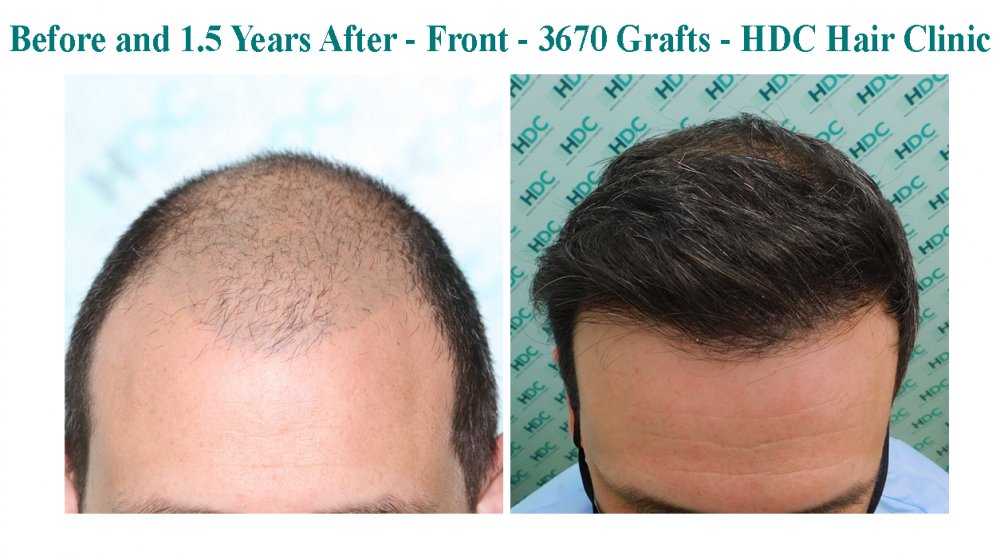 11 - Medium Density HT 28-09-20 for 3670 grafts - Front 2.jpg