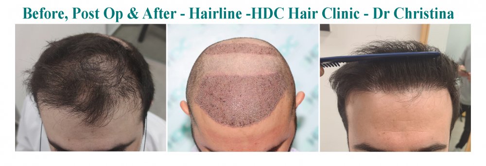 11. Medium HT 28-06-21 3200 + 980 grafts post Jan 22 set 1.jpg