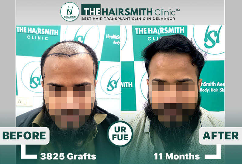 11 months hairsmith hair transplant result - the hairsmith clinic delhi - 1.jpg