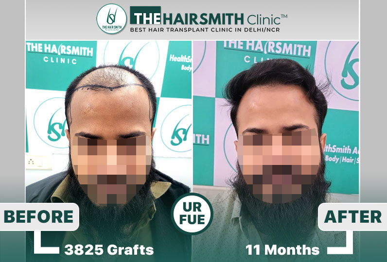 11 months hairsmith hair transplant result - the hairsmith clinic delhi - 2.jpg