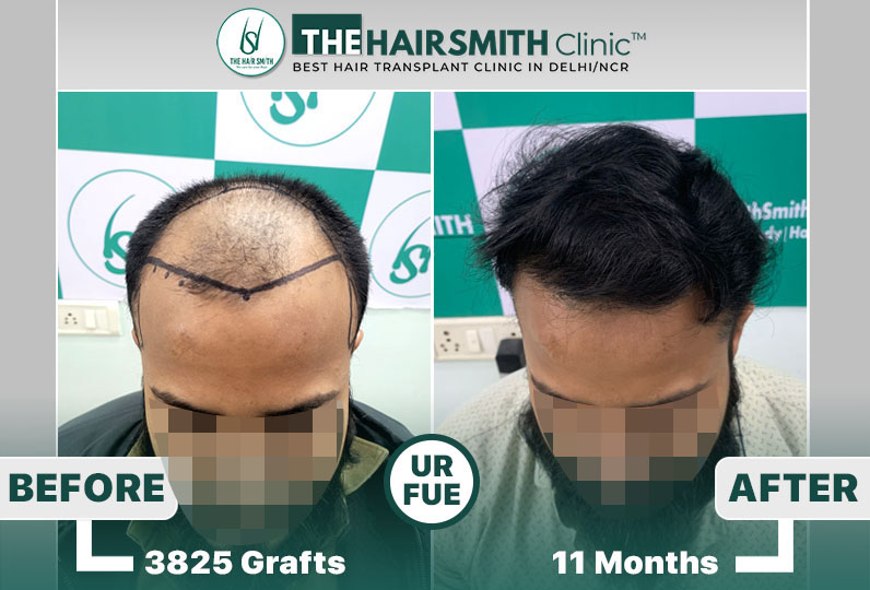 11 months hairsmith hair transplant result - the hairsmith clinic delhi - 3.jpg