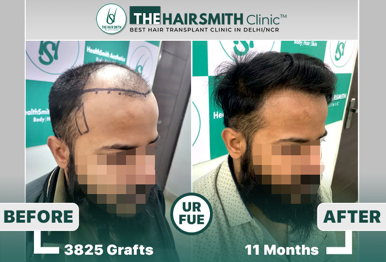 11 months hairsmith hair transplant result - the hairsmith clinic delhi - 4.jpg