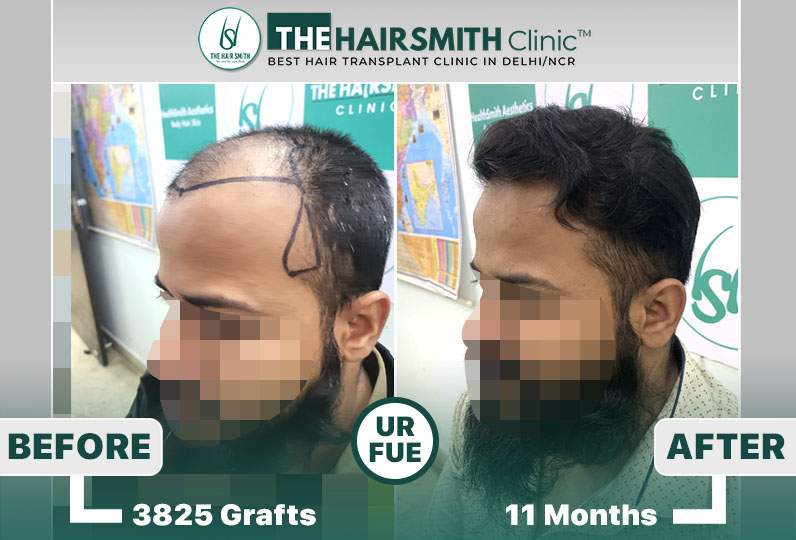 11 months hairsmith hair transplant result - the hairsmith clinic delhi - 5.jpg