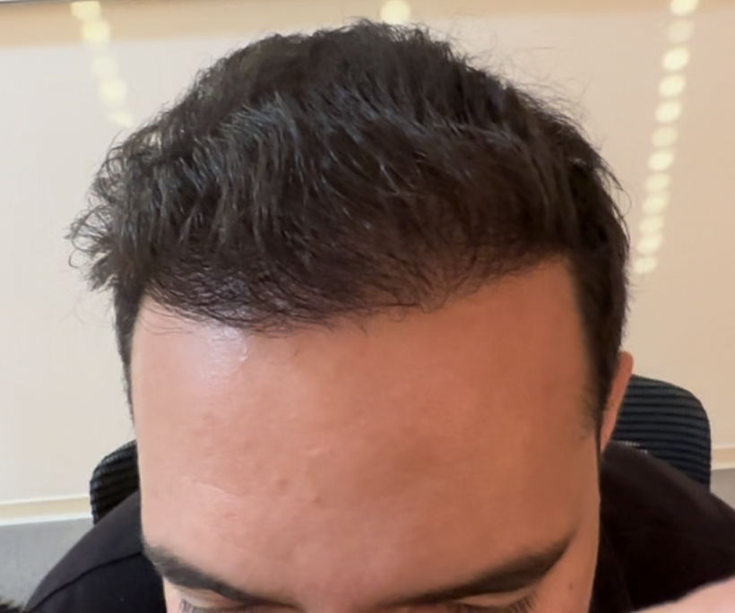 11. Result 8.5 months after hair combed back.png