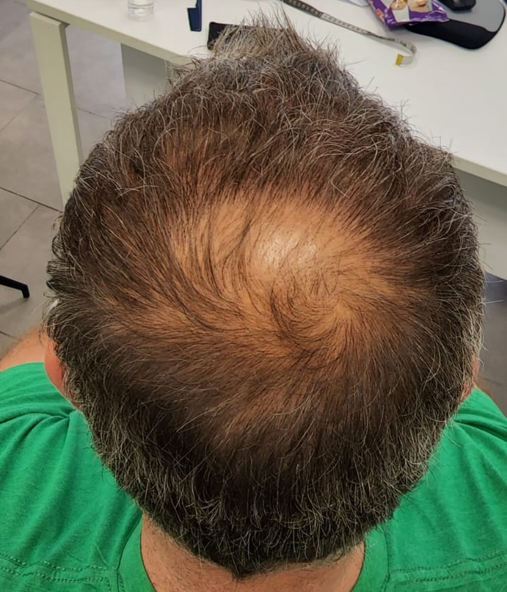 11. Top area growth of FUE1.jpg