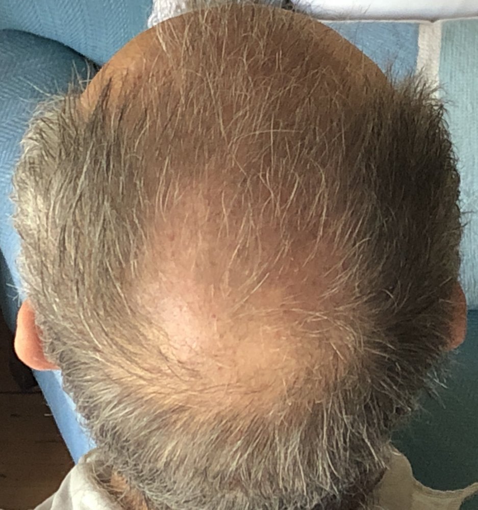 11 weeks post Above Crown 2929.JPG