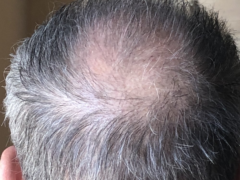 11 weeks post Crown #6.JPG
