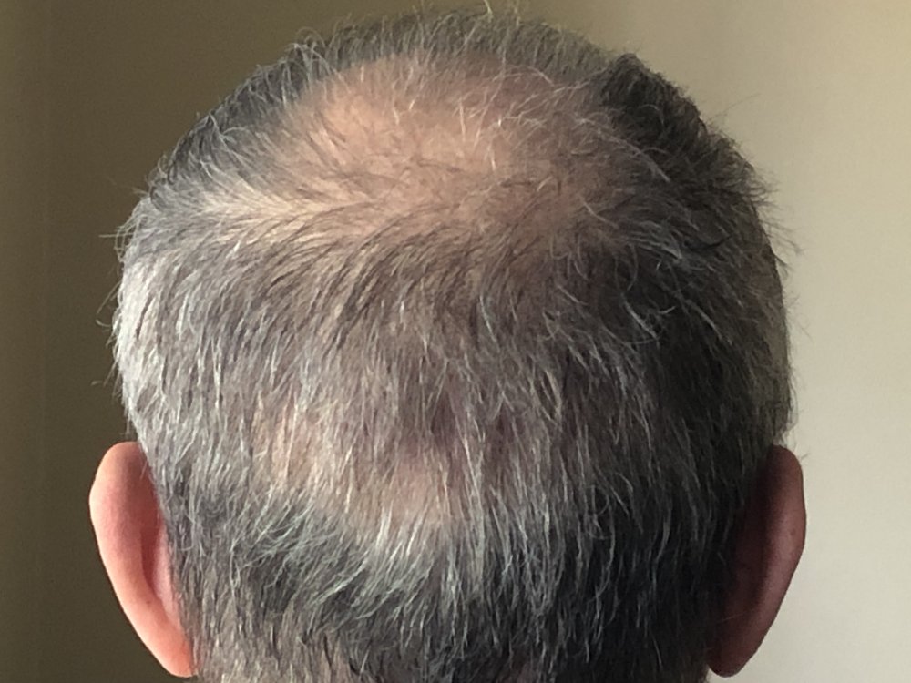 11 weeks post Crown & shock loss 2934.JPG