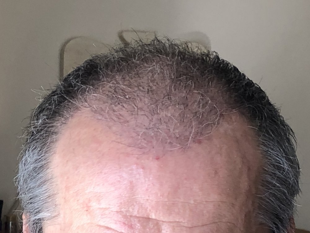 11 weeks post Front 2911.JPG