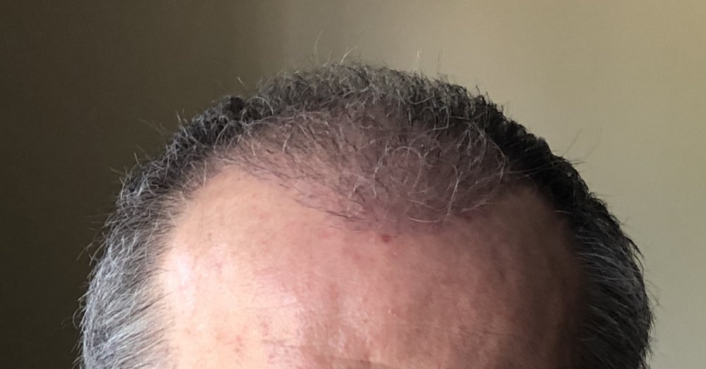 11 weeks post Front 2925.JPG