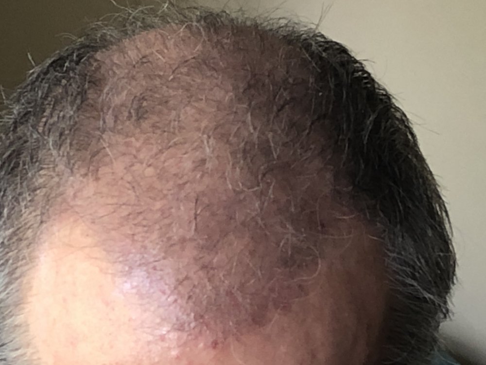 11 weeks post Front 2926.JPG