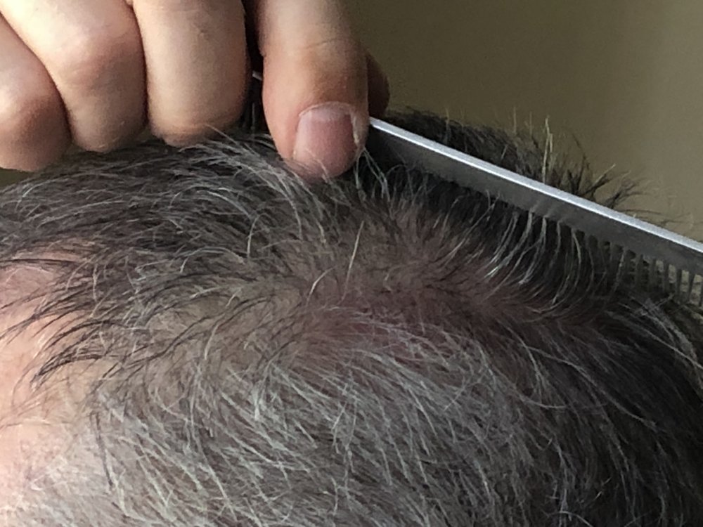 11 weeks post Scar Exposed Left side  2940.JPG