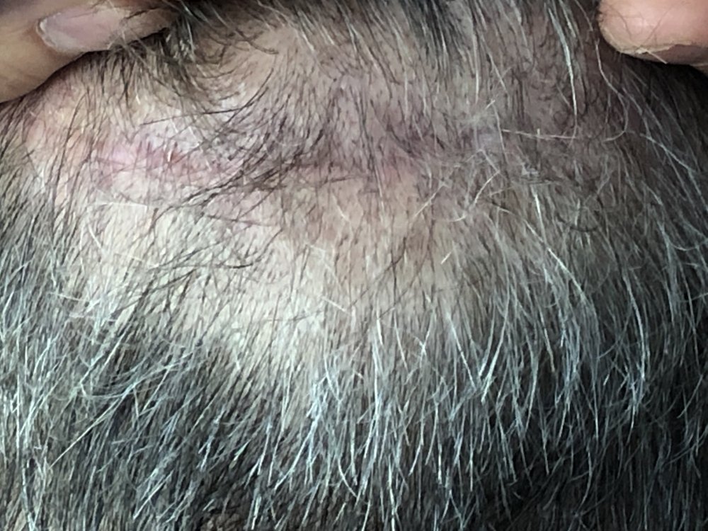 11 weeks post Scar Exposed Rear 2946.JPG