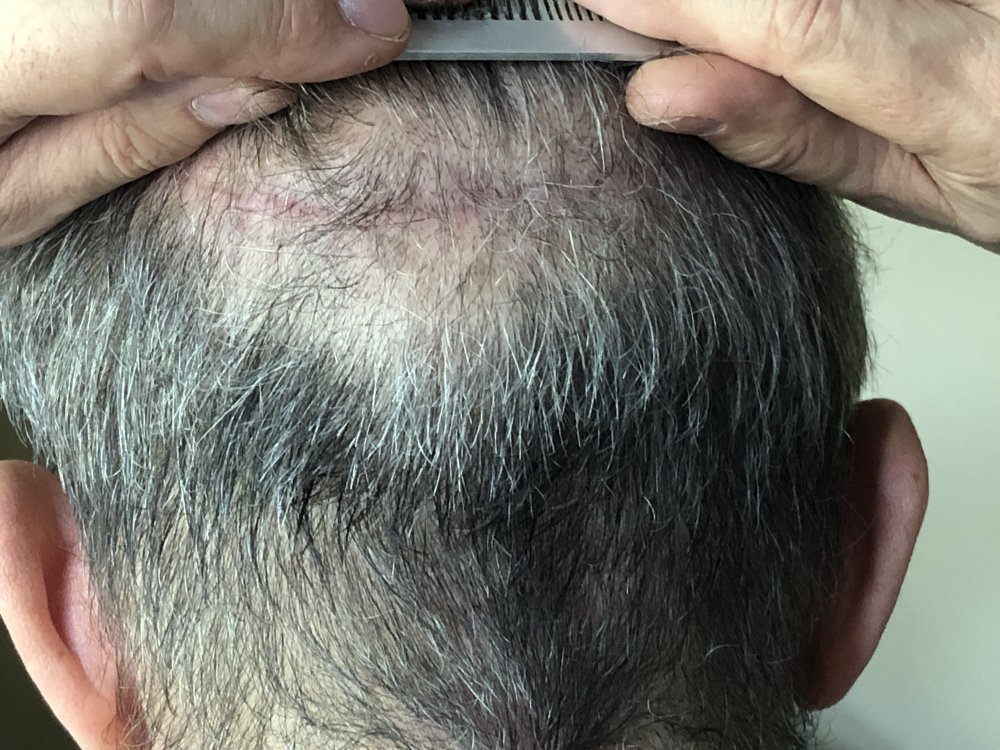 11 weeks post Scar Exposed Rear  2947.JPG