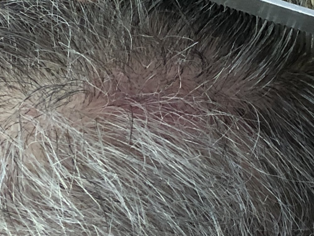 11 weeks post Scar Exposed Right side   2941.JPG