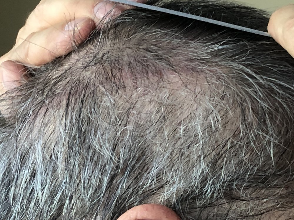 11 weeks post Scar Exposed Right side   2949.JPG